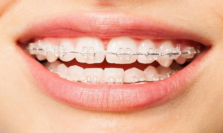 Керамические брекеты - стоматология DENTBLANC в Москве